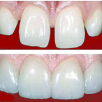 диастема diastema