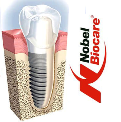 Имплантаты Нобель импланты Nobel Biocare