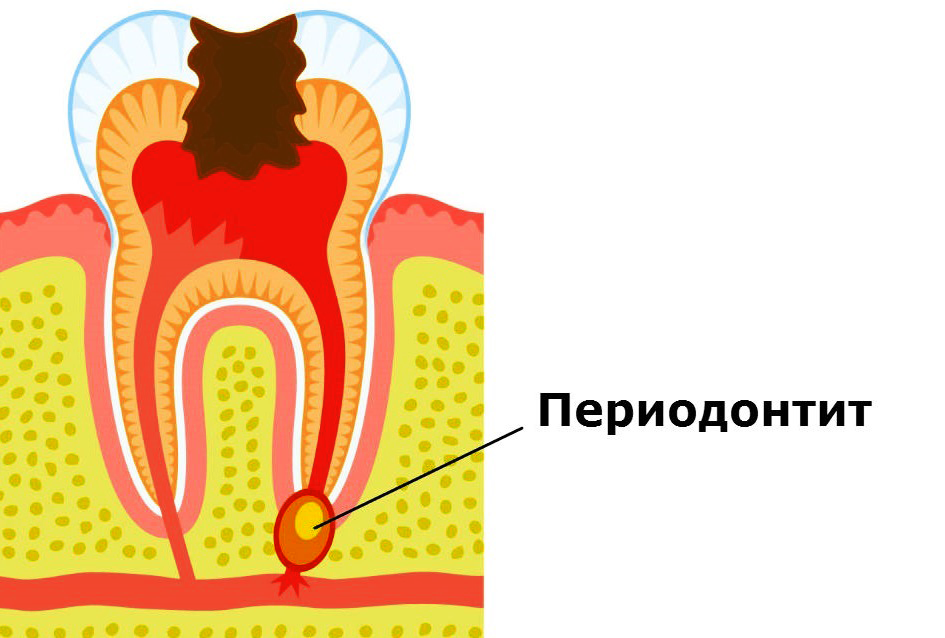 лечение периодонтита лечение периодонтита